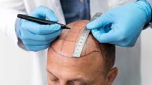 Hair Transplant Turkey Cost – Factors To Consider